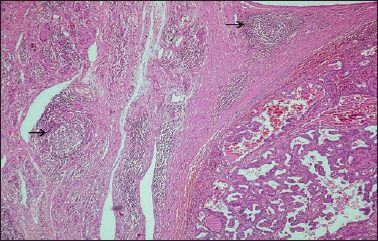 Hashimoto’s thyroiditis in papillary thyroid carcinoma: a 22-year study ...
