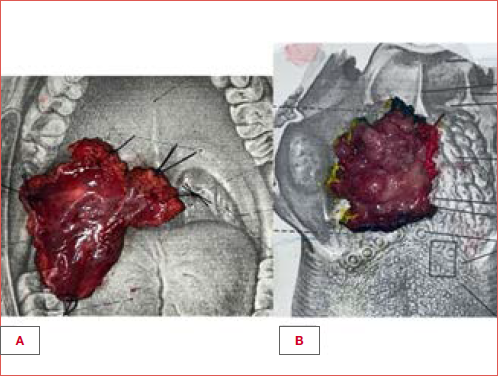 Surgical specimens after TORS for right lateral oropharyngectomy extended to the ipsilateral base of tongue (A) and for right base of tongue resection (B). Note the different colours of marking ink signalling different surgical margins of interest.