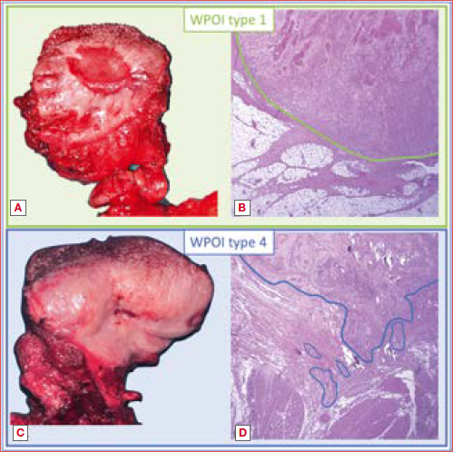 Examples of invasion patterns of oral squamous cell carcinoma: case 1 (A, B) shows an expansive front (worst pattern of invasion [WPOI] 1), while case 2 (C, D) features finger-like projections and isolated nests (WPOI 4).