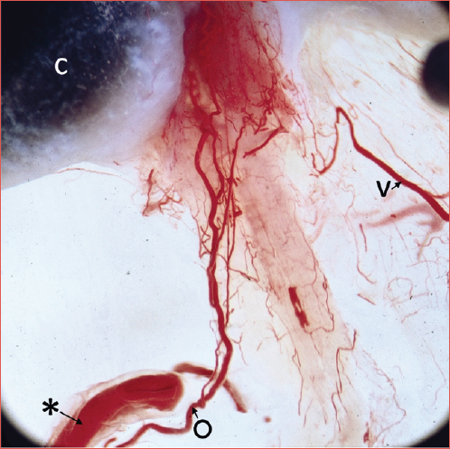 Vascular anatomy from the anterior inferior cerebellar artery (AICA) within the cerebello-pontine angle to the labyrinthine branches and nerves within the internal auditory canal. Temporal bone, injected, osmic acid stained, and microdissected with drilling away of bone from internal auditory canal and exposing the bony labyrinth. Osmic stained cochlea on the left. The facial nerve was removed. The internal auditory artery (IAA) at the lower left supplies, in sequence, branches to the 8th nerve, artery of superior vestibular nerve, common trunk of cochlear artery and cochleo-vestibular artery. A rich network on cochlea-vestibular nerve at the distal internal auditory canal (IAC) is visible. The dura at the right side of the picture shows veins of nerves and dura merging in a collecting vein. C: cochlea; *: proximal limb of AICA; O: internal auditory artery; v: vein.