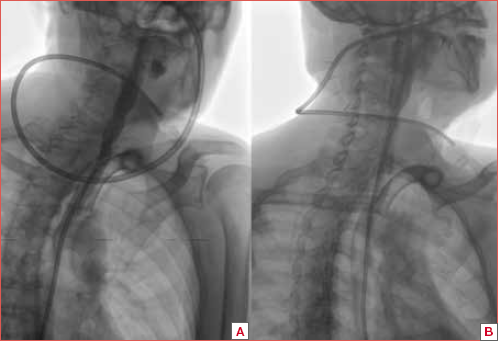 Two scans (A,B) of a patient who has undergone a total laryngectomy and received a Gastrofin swallow. Normal contrast medium transit in the absence of stenosis or fistula.