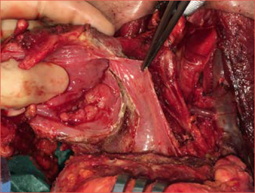 Highlight of margins during pharyngolaryngectomy.