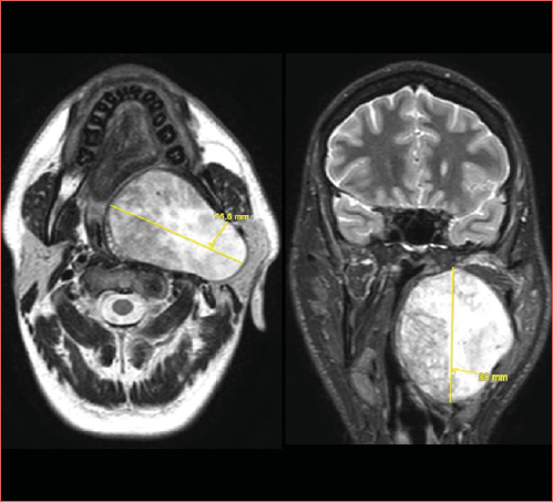 T2-weighted axial and coronal views of a massive pleomorphic adenoma of the left parapharyngeal space. The patient underwent a combined transoral and transcervical procedure.