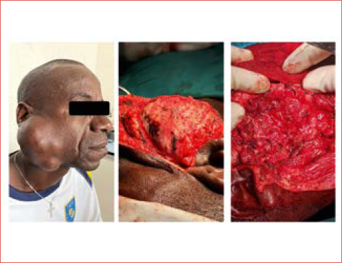 High-grade mucoepidermoid carcinoma of the right parotid gland: clinical presentation and intraoperative view.