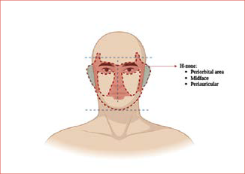 The so-called H zone, with midface, periocular and periauricular areas, is depicted.
