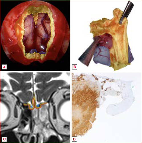 Comprehensive assessment of resection margins in endoscopic skull base surgery. (A) Endoscopic view of the defect following a bilateral endoscopic transnasal craniectomy with en bloc resection of the olfactory bulbs for olfactory neuroblastoma Kadish Stage C. Colour-coded layers denote bone (red), dura (yellow), and olfactory bulbs (blue), with dashed lines indicating the corresponding resection margins; (B) Resected surgical specimen with matching colour codes, illustrating the anatomical layers included in the en bloc resection; (C) Coronal T2-weighted MRI demonstrating the tumour with colour-enhanced delineation of key surgical planes at the skull base; (D) Histopathological examination of the specimen, highlighting the dural margin on the right (marked with ink) and synaptophysin-positive immunohistochemical staining of the olfactory bulb on the left.
