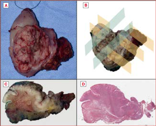 (A) Surgical specimen of a right hemiglossopelvectomy. The tongue is oriented using a suture to indicate the tip; (B) Surgical specimen after formalin fixation, with resection margins marked in different colours of India ink to indicate the midline raphe, the margin on the floor of the mouth, the posterior and the anterior margin (the tip). The margins were assessed on the surgical specimen (sample-driven), which was sectioned using the “radial and perpendicular” method; (C) A macroscopic section of the lingual body obtained by radial sectioning. (D) The corresponding whole slide image stained with haematoxylin and eosin.