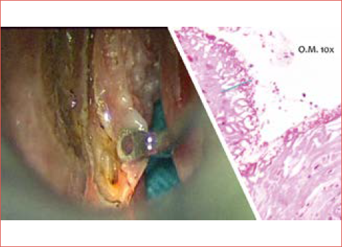 A) Transoral laser microsurgery byCO2 laser for left vocal cord cancer, intraopera-tive view of the posterior resection margin; B) Pathological examination demonstrating minimal thermal damage on the mucosa and underlying tissues caused by the CO2 laser.