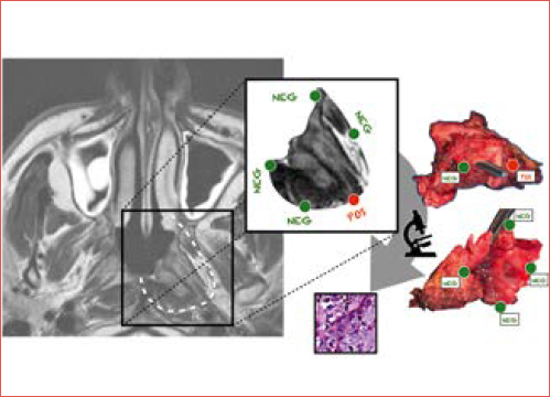 Panel including T2-weighted image of a patient affected by local recurrence of a nasopharyngeal carcinoma in the left lateral recess of the nasopharynx, alongside with schema and photographs of the resected specimen. Location and status of relevant margins are displayed.