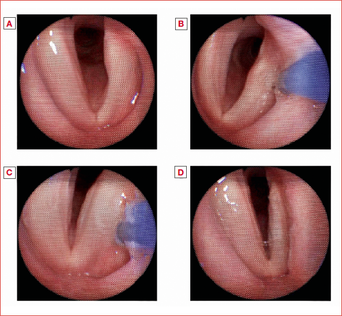 Injection laryngoplasty performed under local anaesthesia through flexible endoscopic phonosurgery. Glottic plane before medialisation (A); first injection site (B); second injection site (C); glottic plane after medialisation (D).