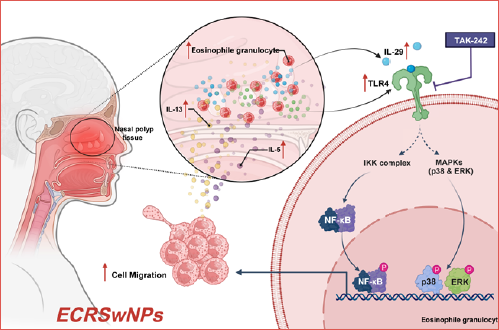 IL-29–TLR4 signalling drives eosinophil infiltration in eosinophilic chronic rhinosinusitis with nasal polyps (ECRSwNP).