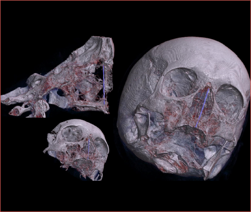 Radiological reconstruction of CT scan showing the spatial relation between the nasopalatine canal and the septal projection of the middle turbinate axilla.