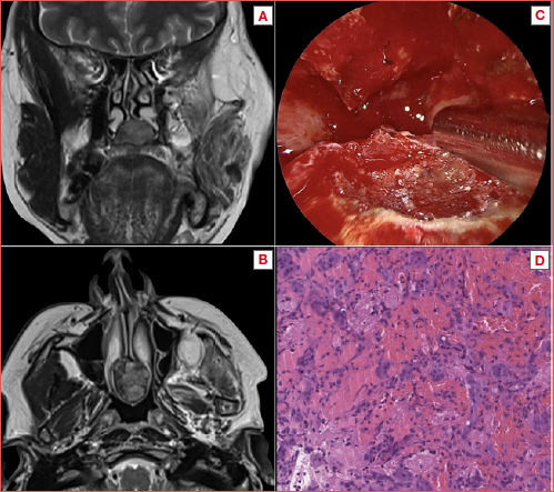 Case 2 from the present series. A-B) Contrast-enhanced MRI T2-weighted sequences showing the lesion centred on the nasal rostrum in coronal (A) and axial (B) view. C) An intraoperative detail during the endoscopic resection revealing the base of implant of the lesion. D) Haematoxylin and eosin stains showing non-capsulated proliferation of spindle-shaped elements with multinucleated osteoclast-like giant cells, incorporating bone tissue.