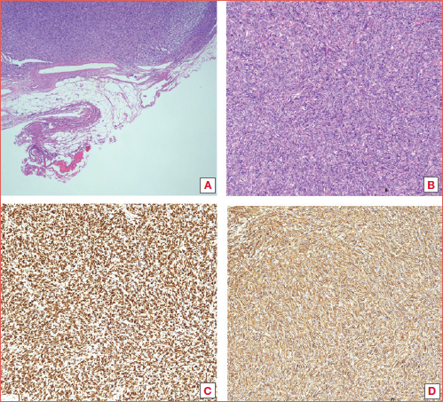 Solitary fibrous tumour/haemangiopericytoma, well-circumscribed in relation to adjacent soft tissue (4×). Ovoid to fusiform spindle cells with indistinct borders, arranged haphazardly or in short, ill-defined fascicles (A,B). Staghorn-like, branching, hyalinised vasculature, hyalinised to collagenous stroma, occasionally with streaming of cells between collagen (10×). Nuclear STAT6 and cytoplasmic CD34 positivity observed (C,D).