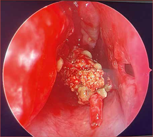 Endoscopic view showing yellow-brown fungal concretions, characteristic of a fungal ball with associated drainage.