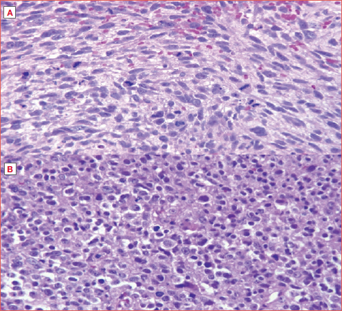 A-B) Histological images in haematoxylin and eosin of dedifferentiated laryngeal chondrosarcoma (courtesy of Dr. Lester D.R. Thompson, USA).