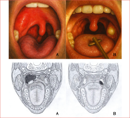 Visual differentiation of intratonsillar abscess (A) and peritonsillar abscess (B) through clinical examination and anatomical illustration.