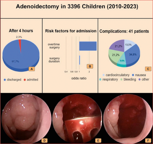 A) Patients discharged after 4 hours; B) Risk factors for unplanned admission: odds ratio are expressed in logaritmic scale, for “surgery duration” it represents the increase in odds ratio when incrementing surgical time by 1 minute; C) Complications associated with surgery; D) Preoperative endoscopic view demonstrating complete obstruction of the nasopharynx by hypertrophic adenoid tissue in a pediatric patient; E) Intraoperative endoscopic view showing the transoral insertion of an adenotome for adenoid removal; F) Postoperative endoscopic image demonstrating complete removal of adenoid tissue.