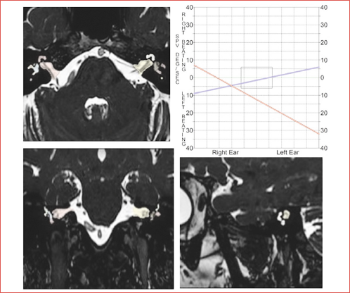 3D-T2w “cisternographic” sequences. Caloric test butterfly graph showing vestibular asymmetry.