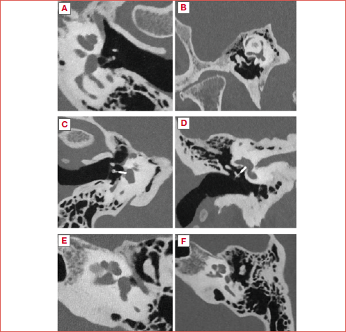Photon counting detector CT acquisition: A and B show the normal anatomy of a healthy ear; C and D show the accuracy in stapedial prosthesis positioning evaluation; E shows a focal demineralisation of the anterior portion of internal auditory canal; F shows a diverticulus.