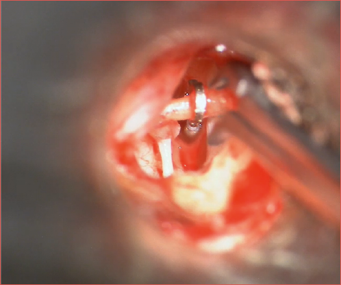 Preparing to crimp the stapes prosthesis to the long process of the incus during a stapedotomy procedure.