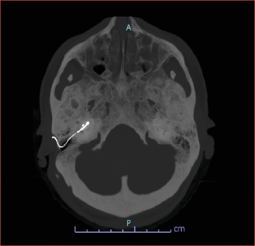 Axial CT of a patient with advanced otosclerosis, showing a right cochlear implant in situ.