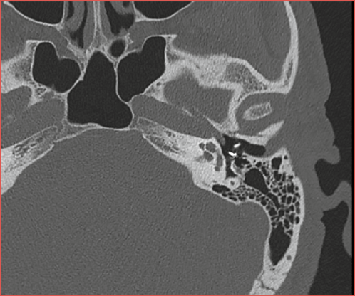 Axial CT scan showing left-sided displacement of a metallic stapes prosthesis in a patient previously submitted to stapedoplasty.