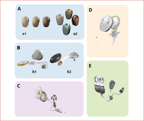 Implantable hearing aids used in patients affected by otosclerosis: A) Percutaneous bone-conduction devices; A1) Ponto System; A2) BAHA Connect; B) Active transcutaneous bone-conduction devices; B1) Bonebridge; B2) Osia2; C) Codacs; D) Vibrant Soundbridge; E) Carina.