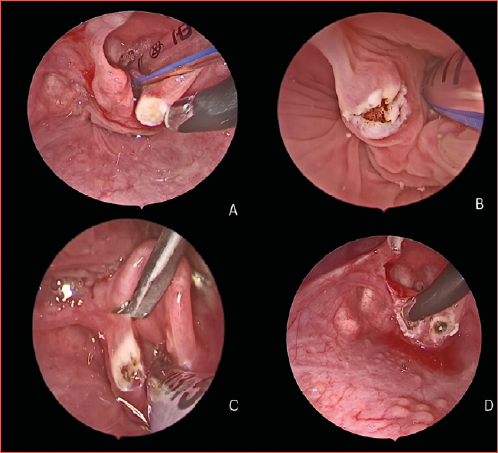 A) Ablation of the mucosa over the postero-lateral aspect of the arytenoids with partial cartilage trimming and cuneiform ablation. Every attempt was made in trying to preserve the surrounding aryepiglottic fold mucosa, especially anteriorly to avoid its shortening and stenosis (right side); B) The same procedure as in Figure 1 was done on the left side; C) Start of the division of the left aryepiglottic fold using a scissor very close to the lateral edge of the epiglottis down to the ventricular fold; D) Appearance of the left aryepiglottic fold after its division.
