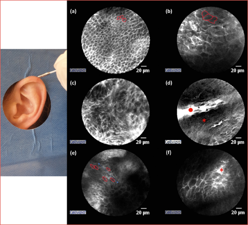 Exemplary image of the examination of a healthy auricle. The probe is held like a pen and moved over the auricle. Confocal laser endomicroscopy images with the typical tissue properties. (A) Healthy tissue is characterised by homogeneous, small, well-defined cells (outlined in red); (B) The basal cell carcinoma (BCC) shows enlarged, poorly demarcated cells (outlined in red); (C) Inhomogeneous tissue in the BCC; (D) Besides cell nests, the BCC also contains cell-free areas with fibrosis (no histologic diagnosis) (red star), shown here next to a capillary (red dot); (E) In some areas of the BCC, cell islands are aligned in a certain direction (blue arrow) (polarisation); (F) Epidermal shadowing can be found in the BCC (red star).