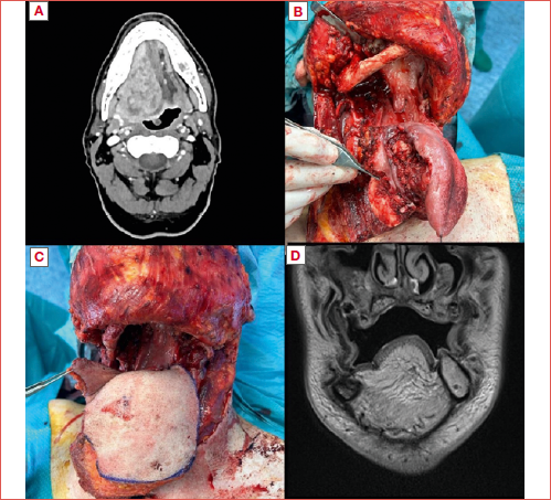 58 year-old male with a cT3N2b primary tumour of the right mobile tongue extending to the ipsilateral base of tongue, crossing the midline at preoperative magnetic resonance (A); he underwent total glossectomy with laryngeal preservation and bilateral neck dissection. Surgical resection was extended to the right lateral wall of the oropharynx and mandible (right marginal mandibulectomy) (B). Reconstruction was performed by a myocutaneous latissimus dorsi free flap (C); Percutaneous endoscopic gastrostomy (PEG) was positioned before surgery and tracheotomy during the procedure. The tracheotomy cannula was removed 11 days later while the PEG remained in situ after discharge. At the last follow-up, 26 months after surgery and adjuvant chemoradiation, he was alive without disease and was eating a semiliquid diet per os integrated by the use of PEG (D). No aspiration pneumoniae was reported.