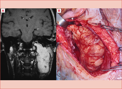 Schwannoma of the left XII cranial nerve: A) appearance at MRI; B) same case, surgical view.