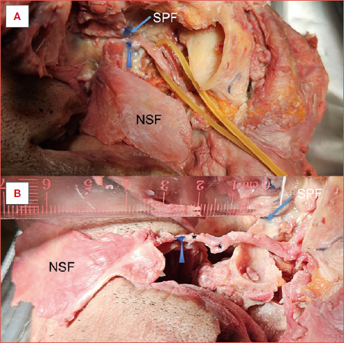 Cadaveric dissection showing nasoseptal flap pedicle elongation. A) Blue marker was used to indicate the margins of the sphenopalatine foramen (SPF, blue arrow) and sphenopalatine artery (SPA) at the SPF (blue arrowhead) before elongation; B) After elongation by transecting the posterior branches (asterisks), greater palatine artery and infraorbital artery, the pedicle is put on some anterior stretch. The distance between the SPF (blue arrow) and SPA (blue arrowhead) is the effective elongation of the nasoseptal flap pedicle. In this case it is less than 3 cm, as expected in the less common single-looped form of the maxillary artery.