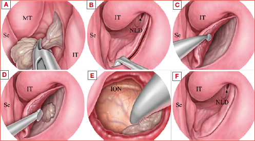 Illustration of the submucosal inferior meatal antrostomy technique for antrochoanal polyp removal. (A) The nasal portion of the lesion (antrochoanal polyp) is removed; (B) A mucosal incision is made along the anterior border of the inferior meatus. Note the posterior location of the nasolacrimal duct; (C) The mucosa is elevated to reveal the bony maxillary wall; (D) The antrostomy is created; (E) The maxillary cavity is inspected with a 45o endoscope, and the polyp is removed from its insertion. Note the infraorbital nerve canal passing along the upper part of the maxillary cavity; (F) The mucosal flap is returned to its original position. ION: infraorbital nerve; IT: inferior turbinate; MT: middle turbinate; NLD: nasolacrimal duct; Se: septum.
