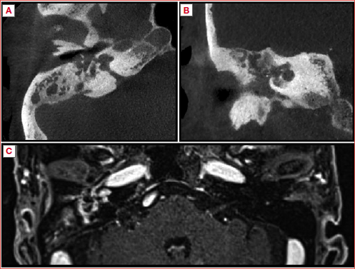 Imaging of a patient affected by granulomatosis with polyangiitis with involvement of the right middle and inner ear. CT images (A: axial plane; B: coronal plane) show right middle ear and mastoid opacification with osteolysis of the bony walls of labyrinth and semicircular canals, along with calcification of the cochlea. T1-weighted MR of the same patient (C), with respect to the left side, shows enhancement of the right middle and inner ear, consistent with chronic inflammation.