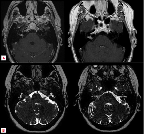 A) Contrast enhanced T1-MRI sequence at diagnosis and after 24 months of wait-and-scan of a right vestibular schwannoma; B) T2-MRI sequence of pre- and post-surgical excision of a right vestibular schwannoma.