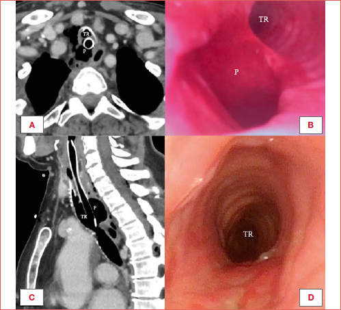 Axial (A) and sagittal (C) computed tomography images of a 75-year-old woman showing traumatic injury of the pars membranacea of the cervical trachea following orotracheal intubation for elective gynaecologic surgery. Endoscopic view of the perforation (B). Patient underwent primary emergent surgical repair by circumferential tracheal opening in between the sixth and seventh tracheal rings, trans-tracheal closure of the posterior tear by a double-layered vertical suture, followed by tracheo-tracheal anastomosis and immediate extubation without tracheostomy. Postoperative result at 30 days after surgery (D). TR: tracheal lumen; P: perforation.