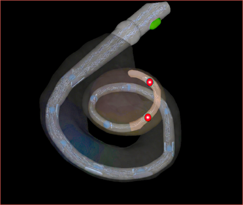 Apical electrodes requiring higher stimulation in Meniere disease (MD). The red dots correspond to electrodes 1 and 2, which require higher stimulation thresholds in patients with MD than in those with other aetiologies.