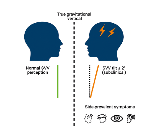 Left: normal alignment of the subjective visual vertical (SVV) with the true gravitational vertical (green). Right: schematic SVV subclinical tilt (orange) relative to the true vertical in a migraine patient, illustrating roll-plane vestibular tone imbalance and lateralized symptoms.
