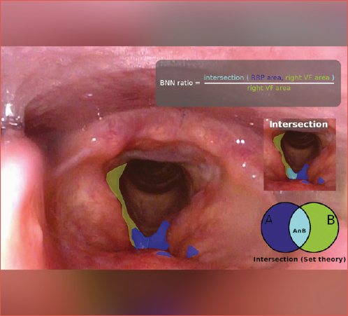 Endoluminal annotation of the laryngeal pathology in a frame extracted from videos obtained during white light laryngoscopy, showing the intersection of the vocal fold area of interest (green) and the recurrent respiratory papillomatosis area of interest (blue).