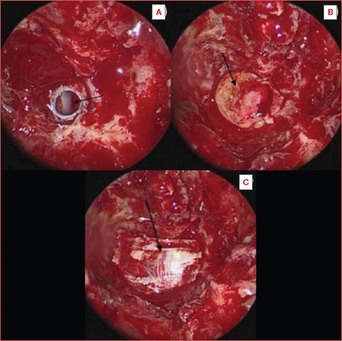 Intraoperative images showing (A) endoscopic view by 0o endoscope with round shaped bony and dural defect with exposure of the basilar artery; (B) grafting of fat and (C) fascia lata (from Georgalas et al., 2020. mod.)