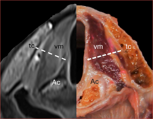 Axial T2-weighted MRI of the glottic larynx, depicting the virtual plane (interrupted line) tangential to the arytenoid (Ac) vocal process and perpendicular to the ipsilateral thyroid cartilage (tc) lamina, dividing the iPGS in an anterior and posterior compartments. Thyroarytenoid vocal muscle (vm) is also indicated for clarity.