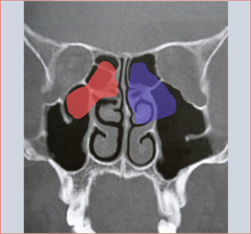 The right side (red) represents functional endoscopic sinus surgery with preservation of the middle turbinate, whereas the left side (blue) depicts a more radical nasalisation approach with resection of the middle turbinate.
