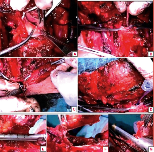 Voice prosthesis placement following four steps: (A) 1 cm median horizontal minipharyngotomy; (B) introduction of a Yankauer suction tube into the oesophageal lumen toward the anterior oesophageal wall; (C) tracheo-oesophageal puncture; (D) introduction of a flexible guidewire into the lumen of the Yankauer suction tube, removal of the puncture needle, ligation of the prosthesis to the guidewire, extraction of the guidewire together with the dilator and the prosthesis. Stapler pharyngeal closure: (E) stapler oriented parallel to the oesophagus (vertical aspect of the “T-suture”); (F) complete suture of the pharynx obtained thorough a vertical suture line together with a horizontal suture line; (G) horizontal suture line (horizontal aspect of the “T-suture”).