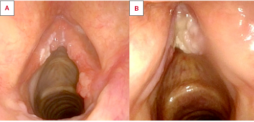 A) Horizontal spread of a glottic tumour from the right vocal cord to the contralateral one passing through the anterior commissure (AC), at a purely glottic level, without supra- and/or sub-AC extension. This tumour is presently categorised by the 8th Edition of the TNM Staging System (8TNM) as cT1b while, according to the present proposal, it should be upstaged to cT2a; B) Vertical trans-AC invasion of a tumour originating within the AC and extending downward to the subglottis. This tumour is presently categorised as cT2 by the 8TNM, while we propose to upstage it to cT2b.