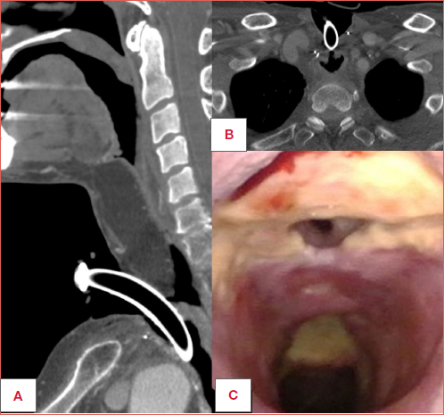 A 56-year old male was treated by total laryngectomy with partial hypopharyngectomy extended to the cervical oesophagus and trachea plus total thyroidectomy, neck dissection and reconstruction with antero-lateral thigh (ALT) free flap for locally advanced adenoid cystic carcinoma arising from the subglottic area and first tracheal rings. After surgery, proton beam radiotherapy was performed. During follow-up he developed hepatic metastasis and lenvatinib was started. Five months later (3 years after surgery without complications) he developed 2 tracheooesophageal fistulas: the cranial one was located just below the tracheo-cutaneous junction at the stomal level, caudally to the inferior end of the ALT skin paddle (A, B, and C), while the distal one was in the mid of the thoracic trachea, 3 cm caudally (C). Swallowing was possible before his Emergency Department admission through the natural way with a cuffed cannula. He discontinued treatment by lenvatinib for 2 months, a jejunostomy was placed, and the situation spontaneously improved in the subsequent 3 months. Surgical closure of the fistulas by direct tracheal suture and interposition of part of the redundant ALT flap in between the oesophagus and trachea was thereafter successfully accomplished. He is now alive and well 3 months after reparative surgery. He never started lenvatinib again and, at present, is treated with vinorelbin per os.