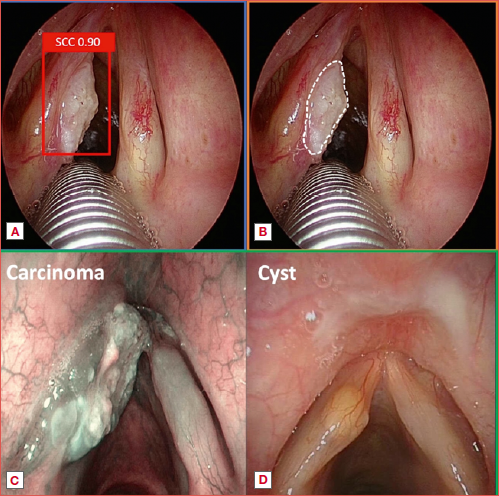 Main task of videomics applied to laryngeal endoscopy. The red box (A) represents the detection of a squamous cell carcinoma with a confidence score of 90%. The same lesion is evaluated, and a superficial segmentation is obtained in the white dotted box (B). C and D show the classification of a left vocal fold carcinoma and cyst, respectively.