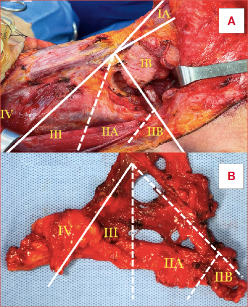 (A) Postoperative anatomy following cervical lymphadenectomy with topographic projection of lymph node levels according to the Robbins classification; (B) En bloc specimen obtained from selective neck dissection encompassing lymph node levels II-IV.