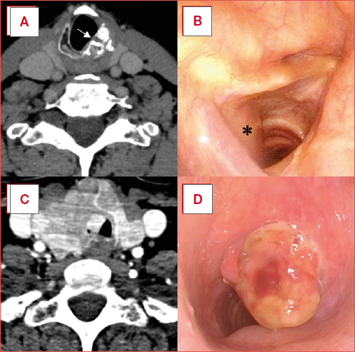 Radiological and endoscopic assessment of laryngo-tracheal tumours. A) axial CT scan showing a cricoid plate chondrosarcoma (white arrow); B) corresponding endoscopic view of the same lesion (black asterisk), showing the typical submucosal bulging; C) axial CT scan illustrating a thyroid carcinoma with extrinsic infiltration of the right junction between the cricoid arch and the first tracheal rings; D) endoscopic appearance of the same patient with evidence of the endoluminal, easily bleeding mass.