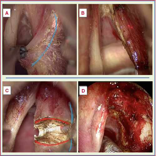 The image illustrates how the assessment and orientation of surgical margins also depend on the type of excision performed (red lines overlaid in transparency: transtumoural margins not to be evaluated; blue lines overlaid in transparency: deep margins to be evaluated). A) Subligamentous dissection plane during a type II cordectomy; B) Surgical bed after a type II cordectomy; C) Trans-tumoural incision during a type Vabcd multi-block resection; D) Surgical bed after a type Vabcd cordectomy.